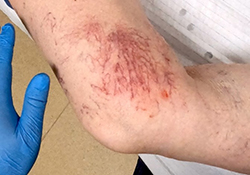 up close image of a knee with red thread veins 